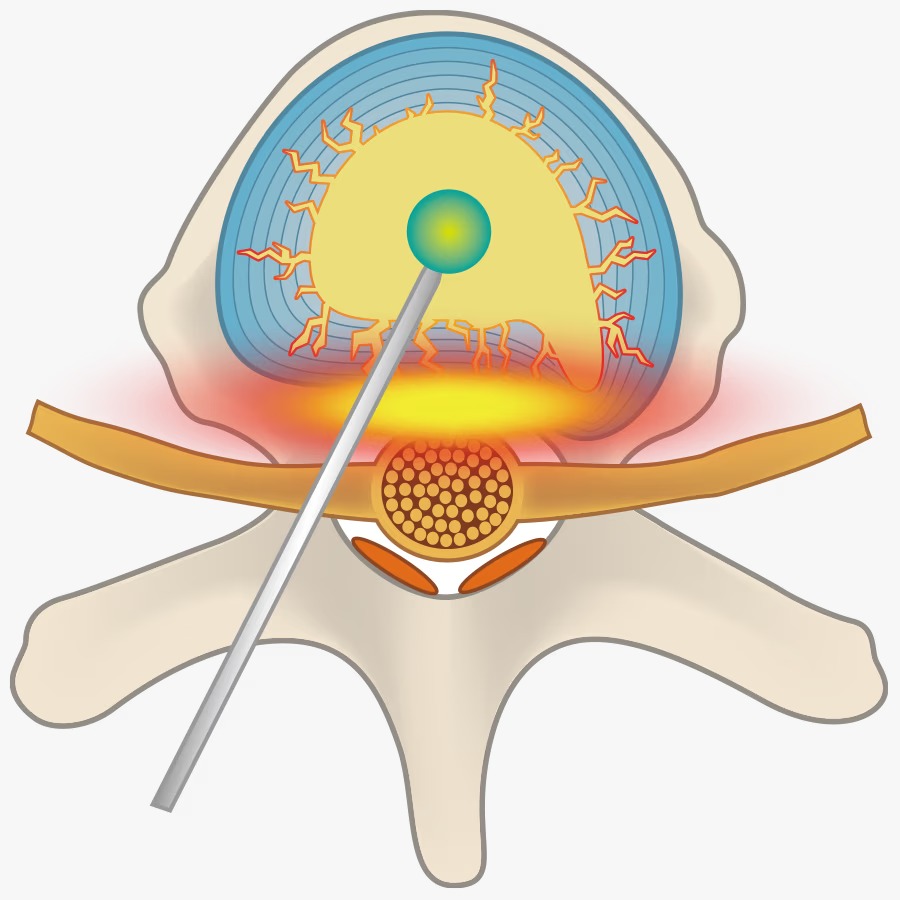Nükleoplasti Bel Fıtığı Tedavisi