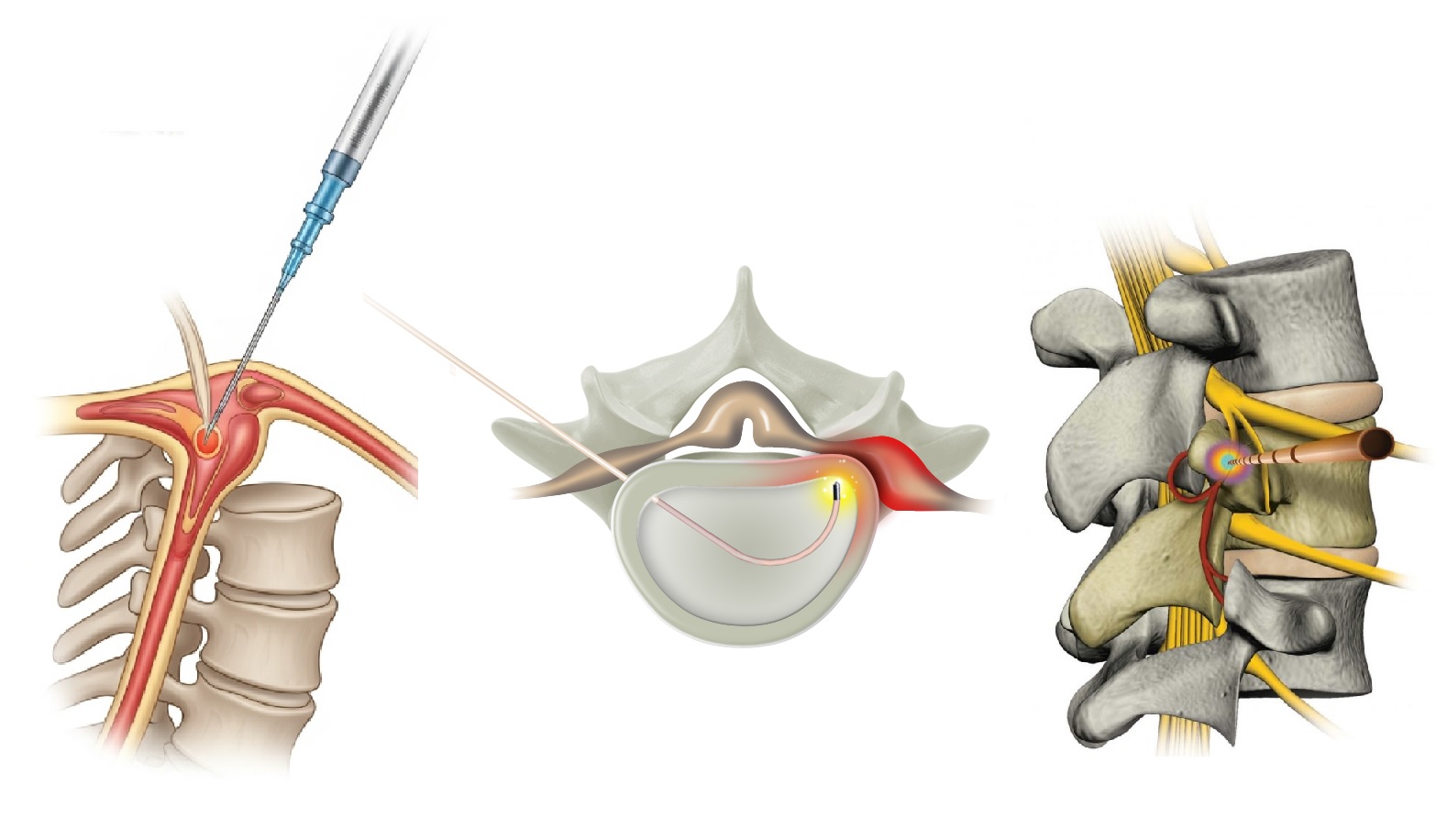 Nükleoplasti, Lazer, Dekompresyon, v.d.
