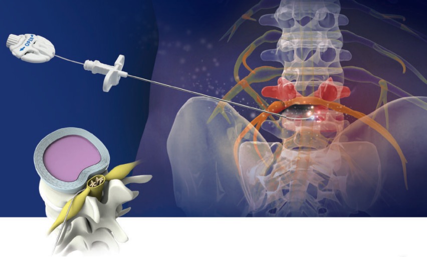 Epidurolisis Tedavisi